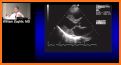 LEARN THE FULL TTE ECHO ULTRASOUND PROTOCOL related image
