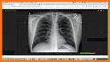 Chest X-Ray Classifier related image