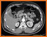 Abdominal CT Sectional Walker related image