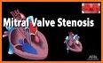 Valvular Heart Disease related image