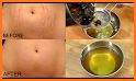 Stretch Marks removing related image