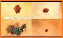 AI Melanoma (Skin Cancer) Detection related image