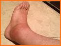 How To Treat A Sprained Ankle related image