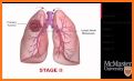 Lung Cancer Stage related image