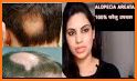 Alopecia Treatment- Home Remedies For Hair Growth related image