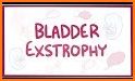 Bladder Exstrophy related image