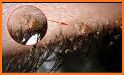Head Lice related image