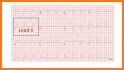 Electrocardiogram (ECG) Rhythm App: Corrected QT related image