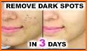 How To Get Rid Of Dark Spots related image