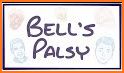 Bell’s Palsy related image