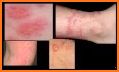 Skin Disease And Treatment related image