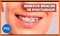 Braces Photo Editor - Braces Filter Colored related image