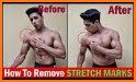 Get Rid of Body Stretch Marks related image