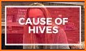 Hives related image