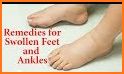 SWOLLEN FEET HOME REMEDIES related image