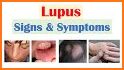 Lupus (SLE) related image