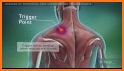 Muscle Trigger Point Anatomy related image
