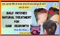 Home Remedies for Hair Care related image