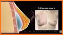 Breast Implant Design related image