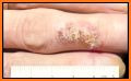 Miiskin - Melanoma Skin Cancer related image