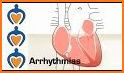 Arrhythmias and Dysrhythmias related image