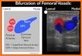 DVT ULTRASOUND related image