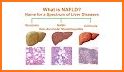 Fatty Liver (NAFL) related image
