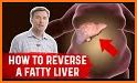 Fatty Liver Diet related image