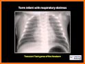 Interpret Chest X-Ray With 100 Cases related image