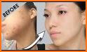 Face Blemish Remover : Smooth Skin-Beautify related image