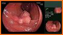 Endoscopic Classifications related image