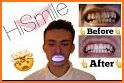 Snow Teeth Whitening related image