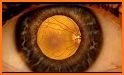 Eye Diagnosis related image