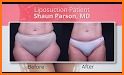 Incredible liposuction related image