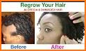 How to get rid of Alopecia related image