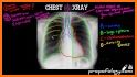 Interpretation Chest X Ray related image