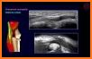 MSK ultrasound Upper Limb related image