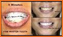 Whiten Teeth Instantly related image