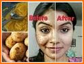 How To Get Rid Of Dark Spots related image