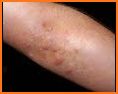 Scabies Natural & Home Remedies related image
