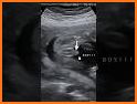 ScanBaby learn baby ultrasound related image