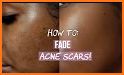 Acne Scar Removal related image
