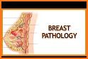 Breast Disease Management related image