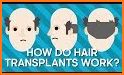 Hair Transplant Simulation related image