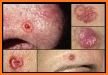 Skin Cancer related image