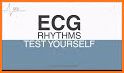 ECG Rhythm related image