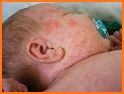 tips sehat dan mudah mengatasi masalah kulit bayi related image