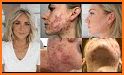 AcneLog: Track your Acne Healing Progress related image